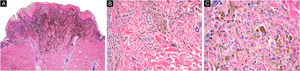 Caso 2. (A) Proliferação melanocítica comprometendo a junção dermoepidérmica e derme superficial, acentuadamente pigmentada (Hematoxilina & eosina, 2×). (B) Células melanocíticas epitelioides e dendríticas dispostas em ninhos, algumas pigmentadas, com sinais de maturação em profundidade (Hematoxilina & eosina, 10×). (C) Células neoplásicas com citoplasma amplo, abundante pigmento melânico granular marrom e núcleos discretamente hipercromáticos e pleomórficos, com nucléolos proeminentes (Hematoxilina & eosina, 40×)