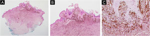 Caso 3. (A e B) Proliferação simétrica de melanócitos epitelioides pigmentados na derme reticular e superficial, dispostos em ninhos e feixes curtos com maturação preservada (Hematoxilina & eosina, 2× e 4×). (C) Melanócitos epitelioides pigmentados com pequeno grau de atipia Hematoxilina & eosina, 10×)