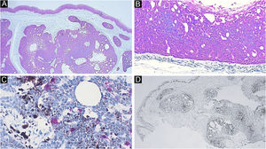 Estudo imuno‐histoquímico. (A) Positividade difusa para citoceratina. Note a epiderme como controle interno positivo (40×). (B) Citoceratina no detalhe positiva na neoplasia. Note aqui também a paliçada periférica e o artefato em fenda entre o estroma da neoplasia e a derme adjacente (100×). (C) Destaque para os melanócitos positivos para Melan‐A. Note o pigmento melânico acastanhado nas células neoplásicas adjacentes (400×). (D) Marcação para Ki‐67 demonstrando células em fase proliferativa, em distribuição predominante periférica no tumor (40×)