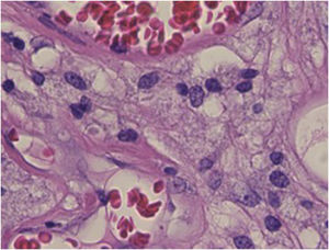 Detalhe da histopatologia: papilas dérmicas preenchidas por numerosos histiócitos espumosos e número aumentado de capilares