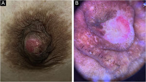 (A) Nódulo firme mostrando erosão central no mamilo direito. (B) A dermatoscopia mostra áreas róseas‐esbranquiçadas e áreas vermelhas sem estrutura