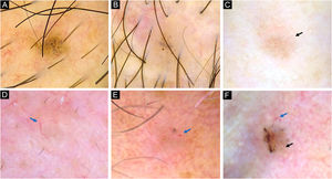 Dermatoscopia de CBCsPD. (A) CBC de 2mm localizado no tórax exibindo pontos e glóbulos azul‐acinzentados. (B) CBC de 2,5mm localizado no couro cabeludo apresentando pontos azul‐acinzentados, glóbulos e telangiectasias curtas‐finas. (C) CBC de 2mm localizado no dorso nasal com pontos azul‐acinzentados e telangiectasias curtas‐finas (seta preta). (D) CBC de 2mm localizado no sulco nasolabial, com pontos azul‐acinzentados e vasos arboriformes (seta azul). (E) CBC de 2mm localizado na região pré‐auricular exibindo glóbulos azul‐acinzentados, telangiectasias curtas‐finas, vasos arboriformes (seta azul) e áreas amorfas brancas brilhantes e cordões. (F) CBC de 2,5mm localizado no canto interno do olho, com pontos, glóbulos azul‐acinzentados, telangiectasias curtas‐finas (seta preta) e vasos arboriformes (seta azul)