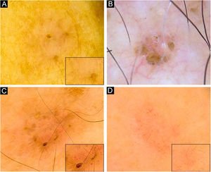 Dermatoscopia de CBCs superficiais de pequeno diâmetro. (A) CBC de 3mm localizado no membro superior exibindo pontos azul‐acinzentados, vasos polimorfos (detalhe aumentado no quadrado) em “grampo de cabelo”, “em vírgula”, vasos glomerulares e lineares irregulares e áreas amorfas e estrias brancas brilhantes. (B) CBC de 3mm localizado no tórax exibindo estruturas em folha, ninhos ovoides, microerosões e escamas brancas. (C) CBC de 3mm localizado no membro superior mostrando pontos e glóbulos azul‐acinzentados, estruturas em folha, vasos polimorfos (detalhe aumentado no quadrado) com telangiectasias curtas‐finas, vasos em “grampo de cabelo” e em “vírgula” e áreas amorfas e estrias brancas brilhantes. (D) CBC de 3mm localizado no membro superior apresentando pontos azul‐acinzentados, vasos polimorfos (detalhe aumentado no quadrado) com telangiectasias curtas‐finas e vasos “em grampo” e áreas amorfas e estrias brancas brilhantes