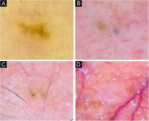 CBCsPD apresentando uma única característica dermatoscópica. (A) CBC de 3mm localizado no membro superior exibindo pontos azul‐acinzentados. (B) CBC de 2mm localizado na fronte apresentando glóbulos azul‐acinzentados. (C) CBC de 1,5mm localizado na região frontal apresentando uma única estrutura em forma de roda raiada. (D) CBC de 2mm localizado no sulco nasal com presença de vasos arboriformes