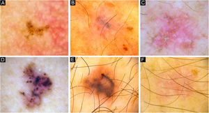 Dermatoscopia de CBCs de referência. (A) CBC pequeno de 4mm de diâmetro localizado na região retroauricular exibindo estruturas concêntricas, pontos e glóbulos azul‐acinzentados. (B) Pequeno CBC de 4,5mm de diâmetro localizado no membro superior apresentando pontos azul‐acinzentados, telangiectasias curtas‐finas, áreas amorfas brancas brilhantes e cordões. (C) BCC médio medindo 8,5mm localizado no membro superior, com presença de glóbulos e pontos azul‐acinzentados, telangiectasias curtas‐finas, microerosões, áreas amorfas brancas brilhantes, cordões e estrias. (D) BCC de 10mm localizado no dorso, com inúmeras características: estruturas em roda raiada, estruturas concêntricas, pontos e glóbulos azul‐acinzentados, ninhos ovoides, vasos polimorfos com telangiectasias curtas‐finas, vasos pontilhados e glomerulares e áreas amorfas brancas brilhantes e cordões. (E) CBC de 5,5mm localizado no dorso apresentando estruturas em folha, ninhos ovoides, pontos azul‐acinzentados, vasos polimorfos em grampo de cabelo, vasos glomerulares e lineares irregulares. (F) CBC de 6,5mm localizado no membro superior exibindo vasos polimorfos com telangiectasias curtas‐finas, vasos em grampo de cabelo e glomerulares, áreas amorfas brancas brilhantes e cordões e escamas brancas