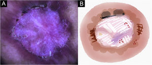 Lesão epitelizada de leishmaniose cutânea no braço do paciente (n=29), trinta dias após o início do tratamento. (A) Dermatoscopia. (B) Ilustração do padrão dermatoscópico: “padrão difuso de área branca sem estrutura”. O “padrão difuso de área branca sem estrutura” é composto por eritema generalizado, área focal branca sem estrutura, linhas brancas, pontos brancos, micro‐ulcerações, vasos polimórficos e áreas focais sem estrutura marrons