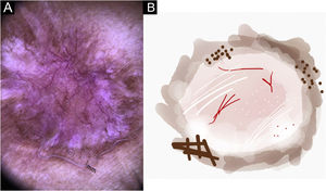 Lesão de leishmaniose cutânea, discrômica‐atrófica, cicatricial, no braço do paciente (n=29) em fase de cura. (A) Dermatoscopia. (B) Ilustração do padrão dermatoscópico “atrófico‐hipercrômico”. O “padrão de áreas focais sem estrutura brancas e marrons” é composto de eritema geral, área branca focal sem estrutura, linhas brancas, pontos brancos, vasos polimórficos (principalmente vasos irregulares lineares), áreas focais marrons sem estrutura, linhas marrons e pontos pretos/marrons