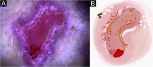 Lesão em placa ulcerada de esporotricose no braço do paciente (n=69), na consulta médica inicial. (A) Dermatoscopia. (B) Ilustração do padrão dermatoscópico “eritema com pústula”. O padrão de “eritema com pústula” é composto por pústula, eritema difuso, úlcera central, micro‐ulcerações, áreas focais brancas sem estrutura, linhas brancas, pontos brancos, áreas focais amarelas sem estrutura e vasos polimórficos (principalmente, vasos irregulares lineares e vasos em “grampo de cabelo”)