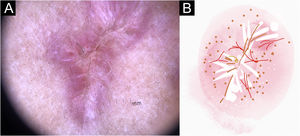 Lesão de esporotricose cicatricial hipertrófica, com disposição linear central, no braço do paciente (n=69), na fase de cura. (A) Dermatoscopia. (B) Ilustração do padrão dermatoscópico “linear branco”. Esse padrão é composto por eritema difuso, linhas brancas, áreas brancas focais sem estrutura, pontos brancos, pontos pretos/marrons, linhas pretas, comedões e vasos polimórficos (principalmente vasos lineares irregulares)