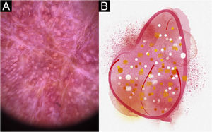 Lesão de esporotricose em placa infiltrada, na face do paciente (n=21) na fase de cura. (A) Dermatoscopia. (B) Ilustração do padrão dermatoscópico “em morango” composto de eritema geral com tampões foliculares, pontos brancos e vasos lineares