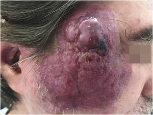 Caso de um carcinoma de células de Merkel em paciente imunossuprimido com síndrome da imunodeficiência adquirida