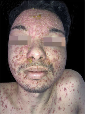 Varicela em paciente transplantado renal. Múltiplas lesões vesico‐bolhosas, majoritariamente monomorfas, sobre base eritematosa, disseminadas pela face, algumas recobertas por crosta melicérica