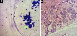 (A) Célula multinucleada com aumento nuclear e aspecto em vidro fosco (citologia de Tzanck). (B) Células epiteliais aumentadas, multinucleadas e núcleos amoldados, com a cromatina em “vidro fosco” (Hematoxilina & eosina, 40×)