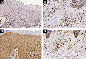 Imuno‐histoquímica de IL‐31RA na pele lesada de um indivíduo com dermatite atópica (DA) na epiderme (A) e derme superficial (B). (A e B) Tratamento pré‐metotrexato (MTX); pele lesada de indivíduo com DA, epiderme (C) e derme superficial (D). (C e D) Tratamento pós‐MTX (ampliação de 200×).