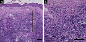 A ‐ Histopatologia da PCSM‐TCLPD. Nenhuma anormalidade óbvia foi observada na epiderme e infiltração difusa de células linfoides foi observada em toda a derme. B ‐ Em maior aumento, um grande número de linfócitos de tamanho pequeno a médio foi visto na derme, com mastócitos, plasmócitos e eosinófilos entre os linfócitos. (Hematoxilina & eosina, barra de escala = 100μm).