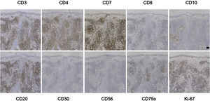Imuno‐histoquímica dos casos de PCSM‐TCLPD. Caso 2. As células neoplásicas expressam fortemente CD3, CD4 e CD7; raramente expressam CD8, CD10 ou CD30, não expressam CD56. (Imuno‐histoquímica, barra de escala = 100μm).