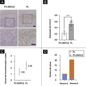 Expressão de 5‐hmC. Doença linfoproliferativa cutânea primária de células T CD4+ pleomórficas pequenas/médias (PCSM‐TCLPD) e pseudolinfoma (PL): diminuição significante da expressão de 5‐hmC foi observada em PCSM‐TCLPD quando comparada com PL na derme (fig. 3A; ****p < 0,0001; fig. 3B). A diferença no escore de imunomarcação nuclear para 5‐hmC foi estatisticamente significante com escores mais altos no grupo PL (média = 2,35, desvio padrão [DP = 0,50]) quando comparado à PCSM‐TCLPD (média = 1,33, DP = 0,47, p = 0,0014; fig. 3C). A maioria dos casos de PL (95%; 19/20) estava no grupo de alta expressão (fig. 3D).