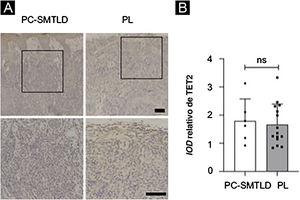 Expressão de TET2: Nenhuma diferença significante na expressão de TET2 foi observada nos dois grupos.