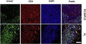 Dupla marcação com imunofluorescência (IF) de 5‐hmC (verde) e CD4 (vermelho) em caoss de PCSM‐TCLPD e PL: Observou‐se diminuição de 5‐hmC em linfócitos CD4+ em PCSM‐TCLPD. DAPI (azul) foi utilizado para mostrar o núcleo da célula.
