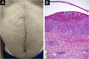 (A) Presença de lesões pustulosas generalizadas em tronco. (B) Exame anatomopatológico demonstrou pústulas intraepidérmicas, subcórneas e infiltrado psoriasiforme (Hematoxilina & eosina, 100×).