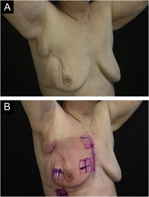 Imagens da mama submetida à radioterapia. (A) Antes da primeira sessão de radioterapia. (B) Após 28 sessões de radioterapia com dose total de 5.221 cGy – radiodermatite grau II é observada, caracterizada por eritema intenso e doloroso e edema mamilar moderado.