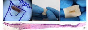 (A) A amostra da biopsia da matriz ungueal é colocada de maneira plana sobre um pedaço de papel filtro, no local correspondente ao diagrama desenhado. (B) Um pedaço de batata de 2×1,5×0,5cm com corte feito com bisturi. (C) O pedaço de batata, com o tecido dentro. (D) Corte longitudinal demonstrando os componentes do aparelho ungueal. Hematoxilina & eosina, ampliação original 40×.