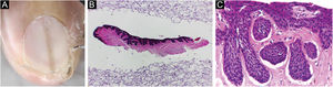 (A) Melanoníquia – dermatoscopia de contato. (B‐C) Onicomatricoma pigmentado: amostra adequadamente incluída em corte longitudinal. Hematoxilina & eosina, ampliação original 40×, 200×.