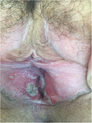 Úlcera fibrinosa com padrão em espelho ou “kissing pattern” na vulva.