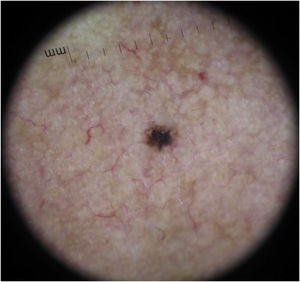 Carcinoma basocelular pequeno, com 1,5mm de diâmetro, caracterizado por estruturas em folha e pontos marrons