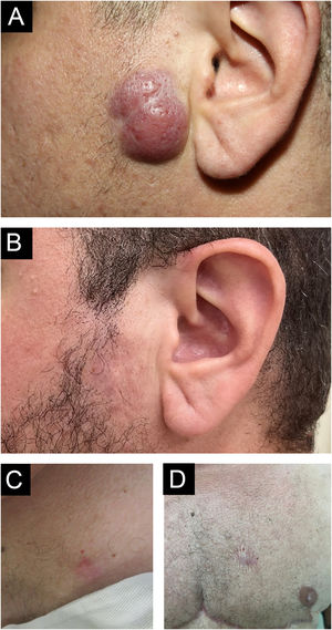 Foto clínica. (A) Tumor eritematoso, infiltrado, de 3cm, assintomático, de crescimento lento, na região pré‐auricular esquerda. (B) Resolução completa após uso de corticosteroides tópicos e intralesionais. (C) Nódulo eritematoso na mama esquerda. (D) Resolução com cicatriz após exérese.