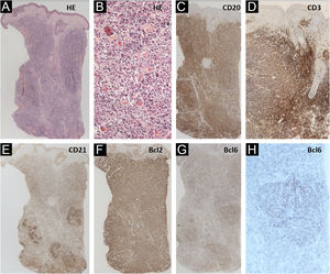 Biopsia de pele. (A e B) Hematoxilina & eosina (10×e 200×) mostrando infiltrado botton‐heavy de pequenos linfócitos, com padrão de crescimento nodular e sem alterações epidérmicas. (C) CD20 (10×) destacando as células B neoplásicas. (D) CD3 (10×) evidenciando o rico infiltrado de células T associado. (E) CD21 evidenciando áreas com esboços de folículos. (F) Bcl2+ (10×) em células B e T. (G e H) Bcl6+ (10×e 40×) dentro e fora dos centros germinativos