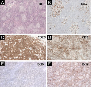 Biopsia de colo uterino. (A) Hematoxilina & eosina (40×) mostrando agregados linfoides em padrão nodular e folicular. (B) Ki67 (200×) com falta de polarização dentro dos folículos neoplásicos. (C) CD20 (40×) destacando as células B esboçando folículos. (D) CD3+ nas células ao redor dos folículos linfoides. (E) Bcl6+ fraco, mas assemelhando‐se às células CD20+. (F) Bcl2− (40×) nos folículos linfoides, com distribuição semelhante às células CD3+