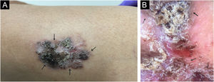 (A) Ao exame, notava‐se placa eritematoacastanhada infiltrada, encimada por área de hiperceratose, na região lateral proximal da coxa esquerda (área coberta). (B) Dermatoscopia evidenciando eritema e vasos lineares na região central, áreas de pigmento enegrecido e vasos glomerulares e pigmento radiado na periferia.