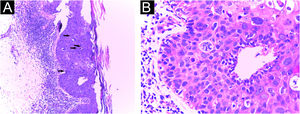 Histopatológico da biopsia incisional, que sugeriu o diagnóstico de CEC in situ pigmentado. (A) Hiperceratose compacta, acantose e depósito de pigmento, além de queratinócitos atípicos e mitoses no terço médio (Hematoxilina & eosina, 40×). (B) No maior aumento, queratinócitos atípicos e mitoses (Hematoxilina & eosina, 400×).