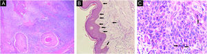 Histopatológico da biopsia excisional. (A) Neoplasia cutânea invasiva constituída de células atípicas e pleomórficas de citoplasma eosinofílico a claro e núcleos pleomórficos com abundante queratinização (Hematoxilina & eosina, 100×). (B) Depósito de pigmento (Hematoxilina & eosina, 40×). (C) No maior aumento, atipia dos queratinócitos e depósito de pigmento (Hematoxilina & eosina, 400×).