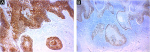 Imuno‐histoquímica. (A) Positividade para antígeno epitelial de membrana (EMA). (B) Positividade para proteína p63.