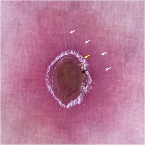 Dermatoscopia de PLEVA. Padrão em alvo típico. A dermatoscopia de contato polarizada revela massa vermelho‐acastanhada central (seta preta), escama intermediária branca focal semelhante a anel (seta amarela) e anel vascular periférico com morfologia polimorfa (setas brancas), consistindo em vasos pontilhados, lineares irregulares e glomerulares, em um fundo rosa‐arroxeado. Essas três zonas concêntricas fornecem uma imagem em alvo típico.