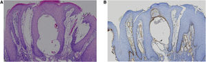 (A) Fragmento de mucosa labial revestido por epitélio escamoso com acentuada acantose, espongiose, hiperceratose e sem atipia de queratinócitos, apresentando infiltrado linfoplasmocitário focal nas áreas mais profundas sem granulomas, com aspecto liquenoide focal (Hematoxilina & eosina, 100×). (B) Imunomarcação positiva para podoplanina em vasos linfáticos subepiteliais (Hematoxilina & eosina, 100×).