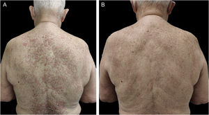 (A) Múltiplas placas anulares eritematosas nas regiões dorsal e cervical posterior na consulta inicial. (B) Resolução completa das lesões após cinco meses em tratamento com doxiciclina 100mg/dia.