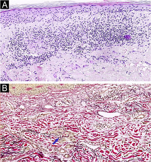 (A) Histopatologia da pele mostrando infiltrado granulomatoso dérmico disperso com fagocitose de fibras elásticas por células gigantes multinucleadas. (Hematoxilina & eosina, 100×). (B) Elastofagocitose por células gigantes multinucleadas demonstrada pela coloração das fibras elásticas. A seta azul indica a elastofagocitose. (Verhoeff‐Van Gieson, 100×).