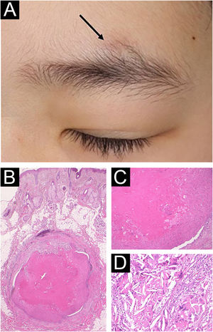(A) Nódulo subcutâneo cupuliforme acima da sobrancelha esquerda (seta). (B) Exame histopatológico mostrando estrutura cística localizada no tecido subcutâneo (Hematoxilina & eosina, 20×). (C) Aumento maior mostra que as paredes do cisto queratinizam em direção ao lúmen sem formação de camada granulosa (Hematoxilina & eosina, 200×). (D) Cristais de colesterol e células gigantes tipo por corpo estranho (Hematoxilina & eosina, 200×).