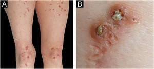 (A) Pápulas eritematosas na face anterior das coxas e joelhos. (B) Detalhe dos tampões hiperceratóticos aderentes centrais.