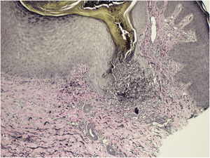 Histopatologia da biopsia de pele mostrando eliminação folicular de fibras elásticas (mostradas em preto) e colágeno (estruturas eosinófilas; Verhoeff, 100×).