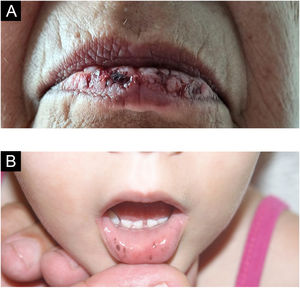 (A) Erosões no lábio inferior em pênfigo vulgar mucoso (cortesia Prof. Hiram Larangeira de Almeida Jr.). (B) Síndrome de Peutz‐Jeghers