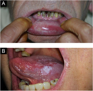 (A) Carcinoma verrucoso. (B) Leucoplasia