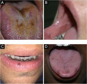 (A) Língua nigra pilosa. (B) Linea alba. (C) Mácula melanótica oral. (D) Hiperpigmentação fisiológica