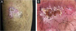(A) Lesão em placa infiltrada, com superfície recoberta por escamo‐crostas localizada no antebraço direito. (B) Dermatoscopia sob luz polarizada evidenciou fundo rosa avermelhado (asterisco), escamas (seta preta), estruturas ovoides laranja‐avermelhadas intercaladas com pontos marrons (seta amarela) e lagos vermelhos extravasculares em área não recoberta por escamo‐crostas (ponta de seta)