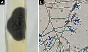 (A) Cultura de coloração negro‐esverdeada, aspecto aveludado e elevação central (Agar Mycosel). (B) Microcultivo com presença de esporulação tipo Cladosporium com conidióforos, eretos, de cadeias curtas com dois a três conídios (Coloração: azul algodão). Fonsecaea spp