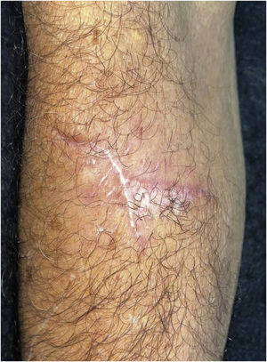 Pós‐operatório tardio dois meses após cirurgia excisional