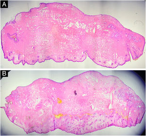 Histologia de dois casos com aumento de 2,5 coradas por Hematoxilina & eosina mostrando toda a margem lateral e profunda.